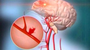 Як високий, так і низький загальний холестерин підвищує ризик розвитку субарахноїдального крововиливу в мозок