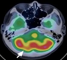 Головний біль і біль в шиї - грозний симптом інсульту, пов'язаний з патологією хребетних артерій