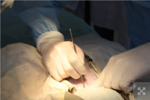 Українські лікарі спільно з польськими колегами вперше успішно пересадили легені